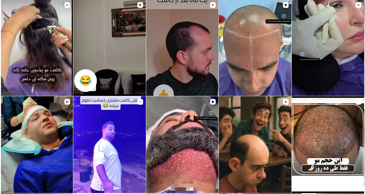 نمونه کار کاشت مو حامد مدبری